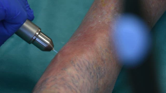 Medical procedure on a patient's leg with plasma flames