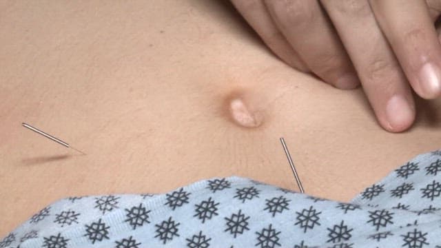 Close-Up of Acupuncture Treatment on Skin