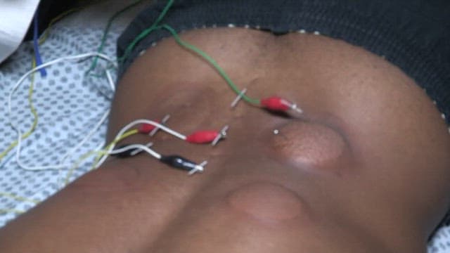 Electroacupuncture Therapy Performed in Oriental Medicine Clinics