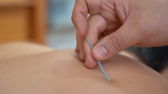 Doctor carefully inserts acupuncture needles into a patient's back