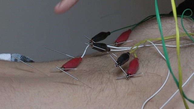 Electroacupuncture Therapy Performed in Oriental Medicine Clinics